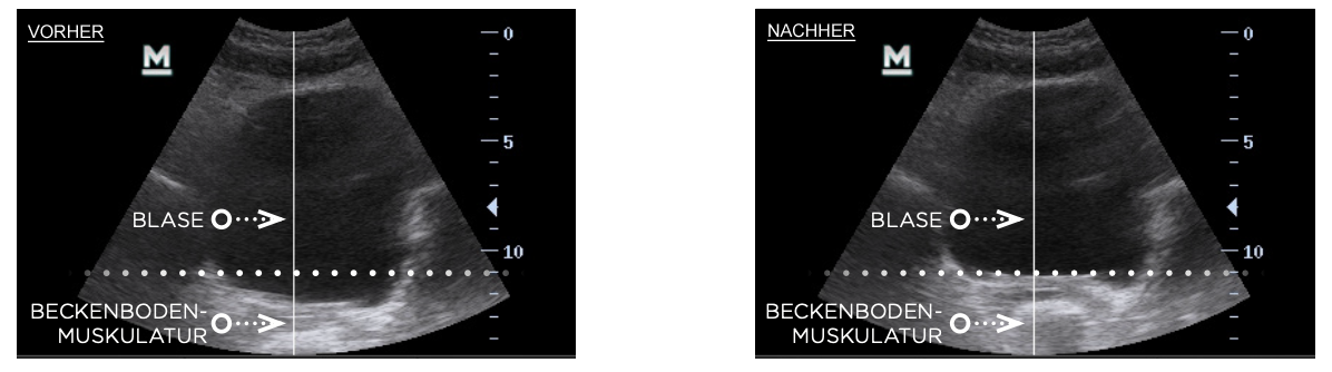 Ultraschallaufnahmen | EMSELLA®-Therapie